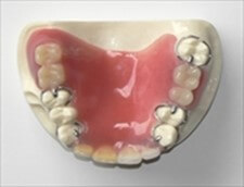 プラスチック義歯（保険適用）1
