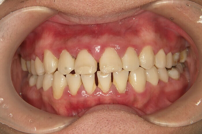 歯周病によって引き起こされる全身疾患のリスク1