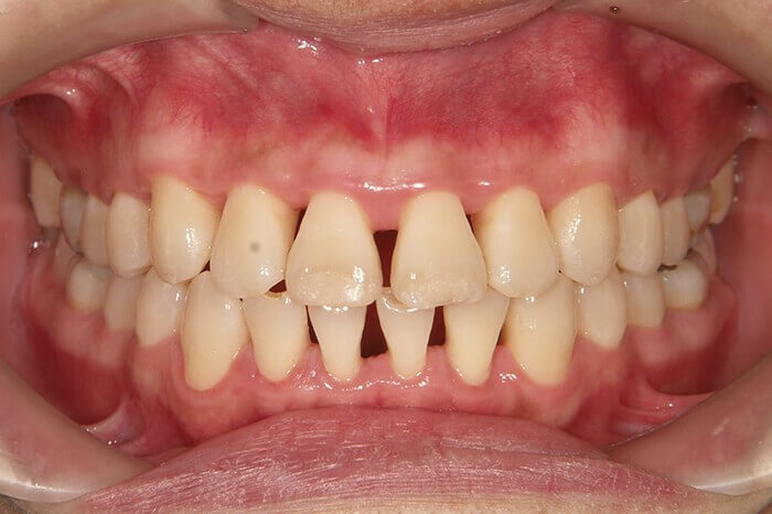 歯周病によって引き起こされる全身疾患のリスク2