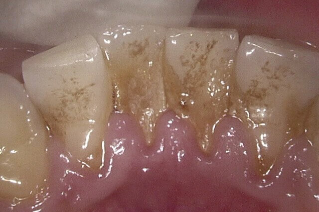 八木歯科の予防治療1