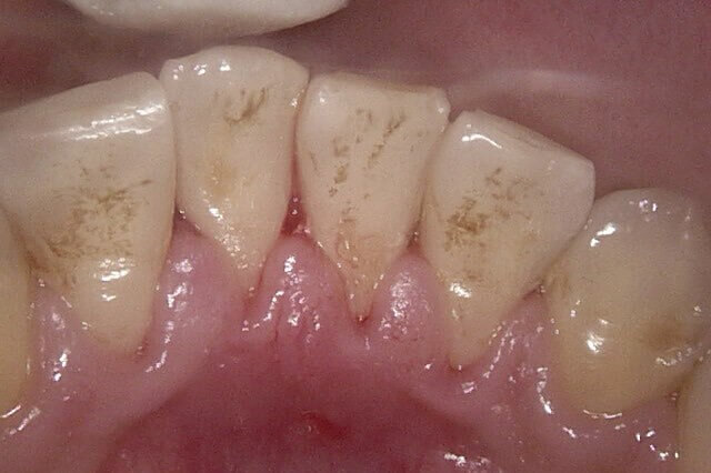 八木歯科の予防治療2
